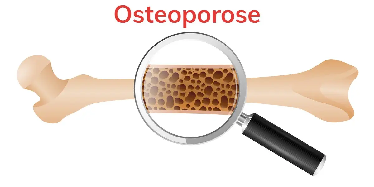 ostéoporose